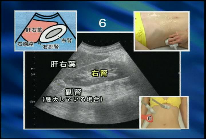 の」の字2回走査法で出来る ! 超音波手技大原則｜医師向け医療