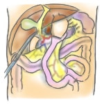 「S状結腸切除術」をいろんな画風で描いてみた