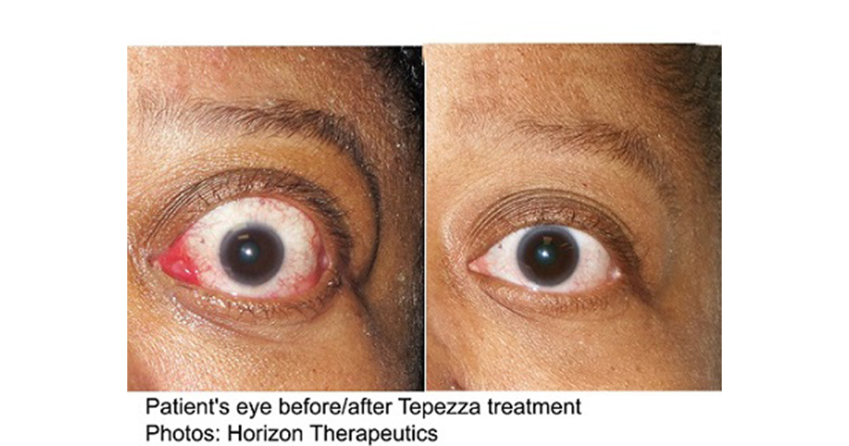 失明リスクもある甲状腺眼症に初の治療薬 米fdaが承認 医師向け医療ニュースはケアネット