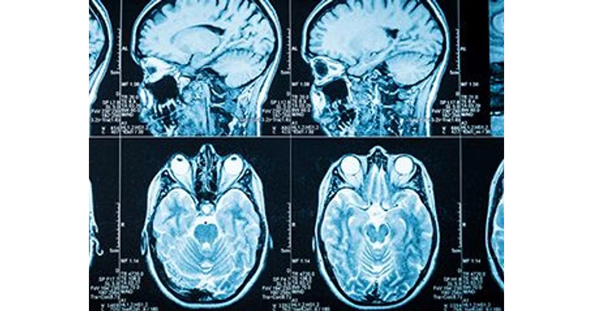 前糖尿病の段階から認知症リスクが上昇する