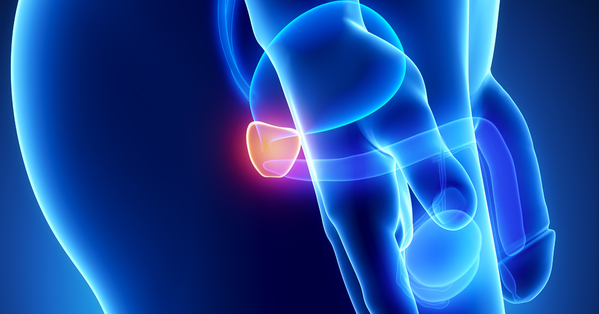 PTEN欠損mCRPC、ipatasertib+アビラテロンでPFS延長/Lancet