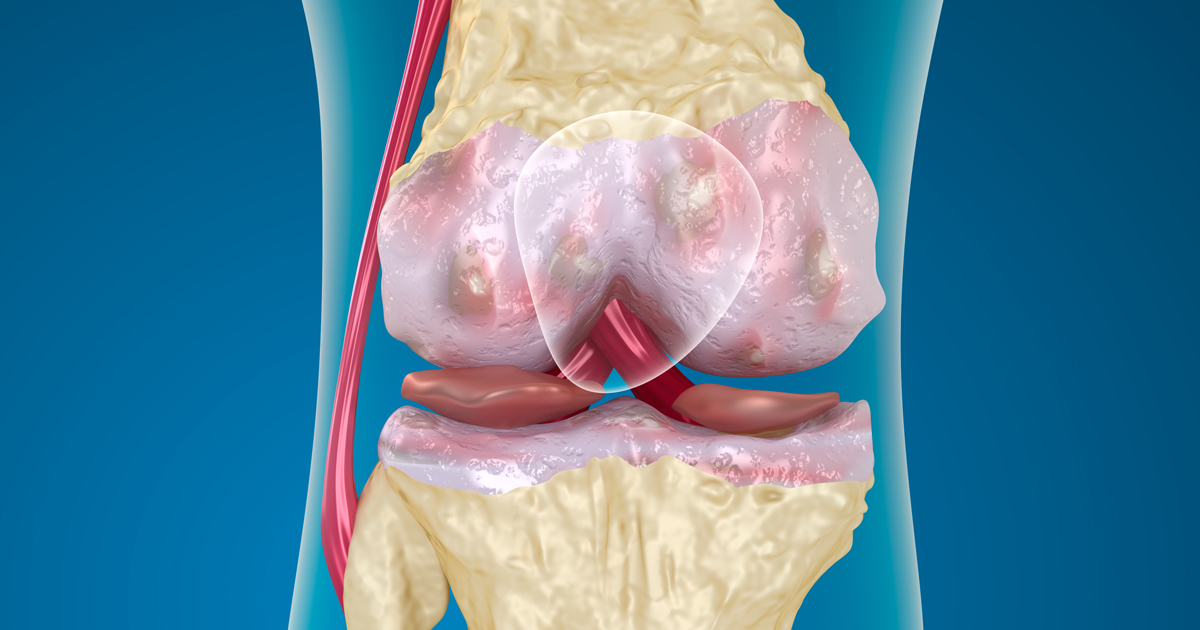 新規経口抗凝固薬milvexianが術後VTE予防に有効/NEJM