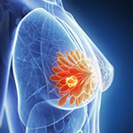 早期乳がん術前化学療法、pCRは代替エンドポイントには役不足／BMJ
