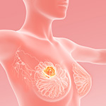 早期乳がんへの術後パルボシクリブ、iDFSに減量・中止の影響は？（PALLAS）／JCO