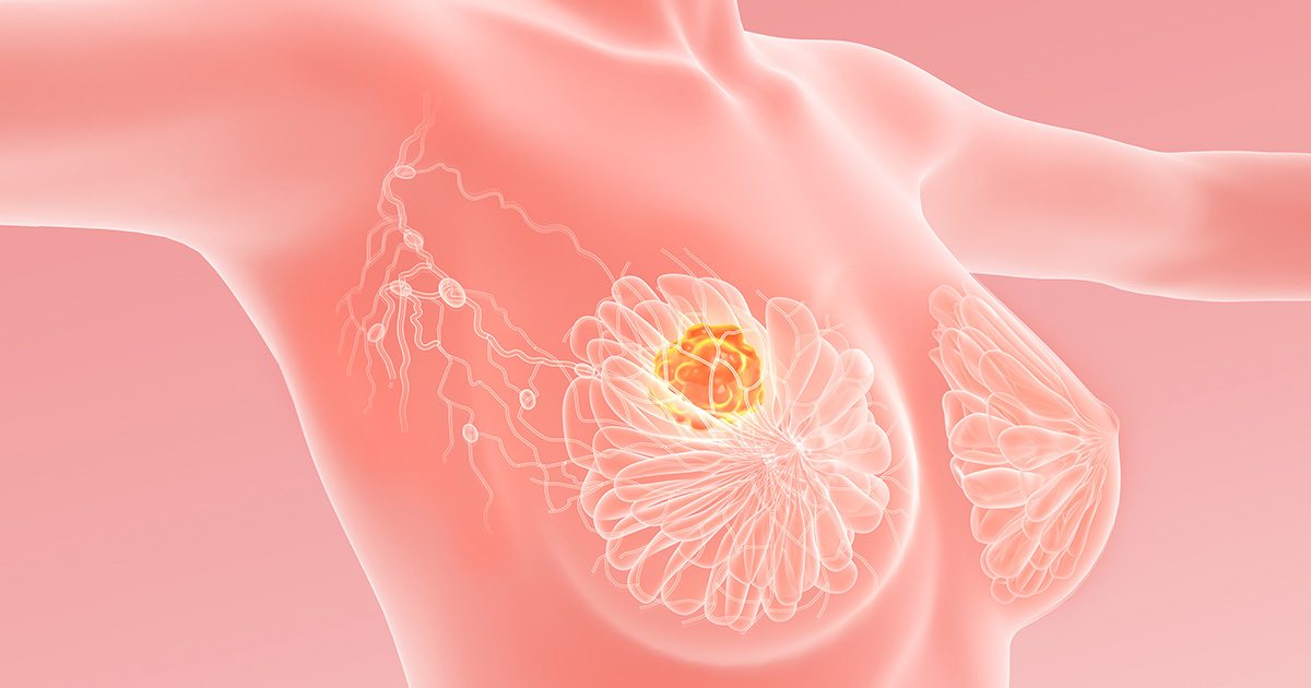 早期乳がんへの術後パルボシクリブ、iDFSに減量・中止の影響は？（PALLAS）／JCO