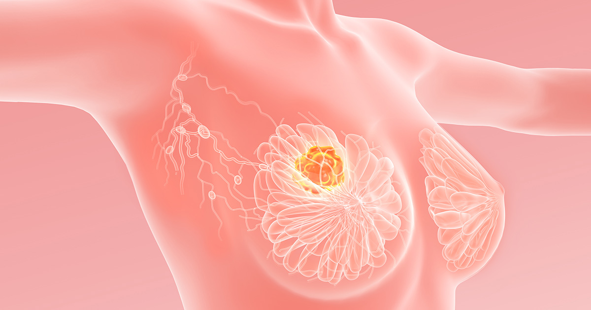 早期乳がんへの術後パルボシクリブ、iDFSに減量・中止の影響は?(PALLAS)/JCO