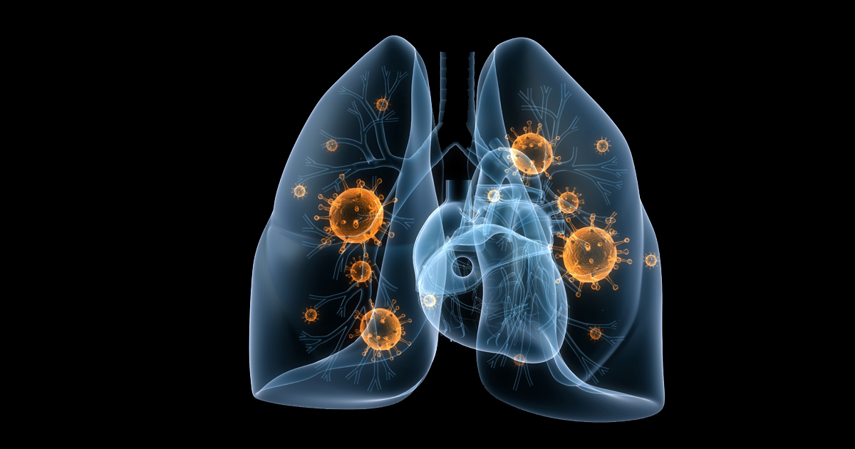 肺がんCCRTのデュルバルマブ維持療法の5年解析（PACIFIC）／JCO｜医師