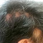 バリシチニブ、円形脱毛症の毛髪再生に有効か／NEJM