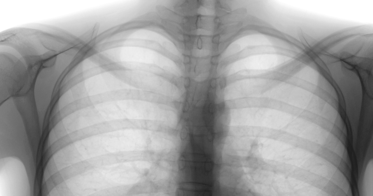 2価RSVpreFワクチン、第IIa相チャレンジ試験で有効性を確認/NEJM