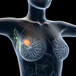 早期乳がんへの術前抗HER2療法＋アテゾリズマブ、pCR61％（Neo-PATH）／JAMA Oncol