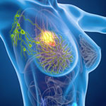 非低リスクの非浸潤性乳管がん、ブースト照射が再発抑制／Lancet
