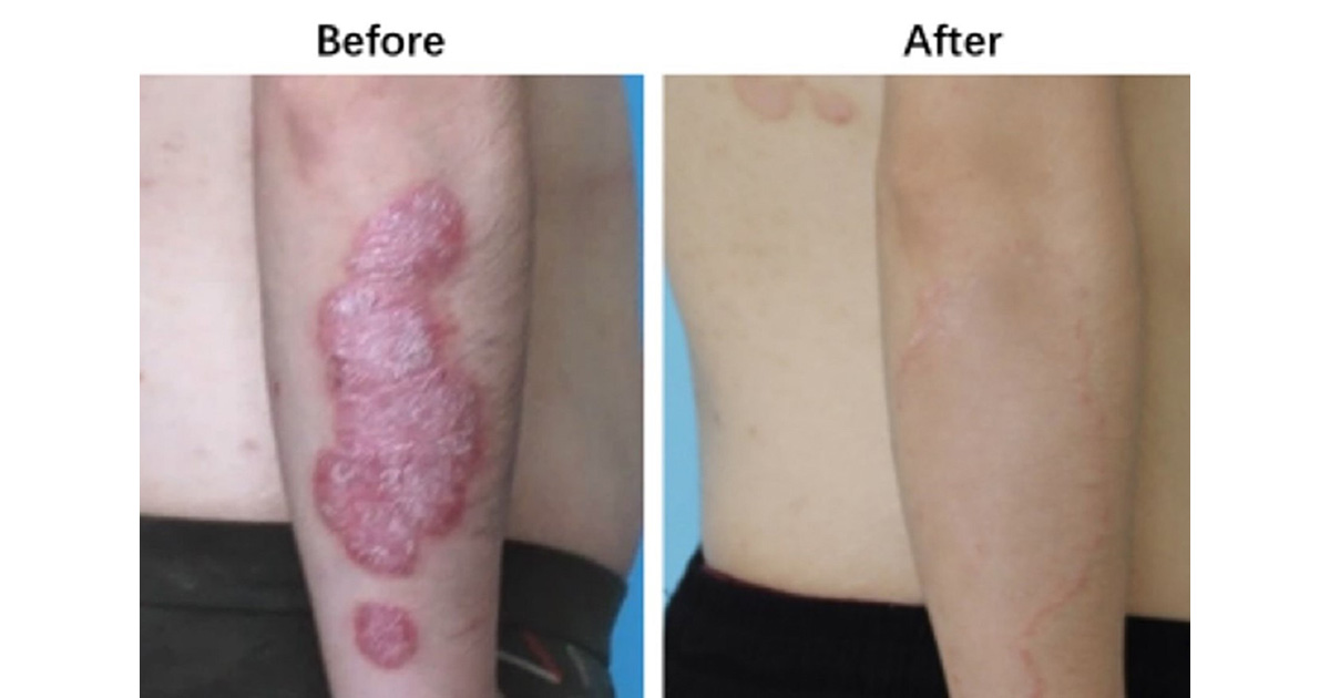 乾癬の全身治療と局所治療の主な違いは何ですか?