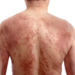 アトピー性皮膚炎、JAK阻害薬はVTE発生と関連するか？