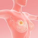 ペムブロリズマブ、高リスク早期TN乳がんへの術前・術後療法に適応拡大／MSD