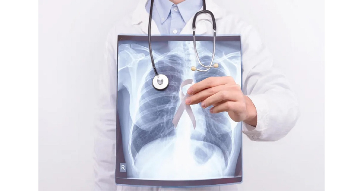 肺がんの放射線治療期間の延長は患者の死亡リスクを上げる