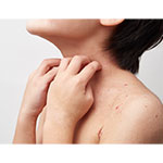 アトピー性皮膚炎の湿疹とかゆみ、臨床で推奨される測定手法は？