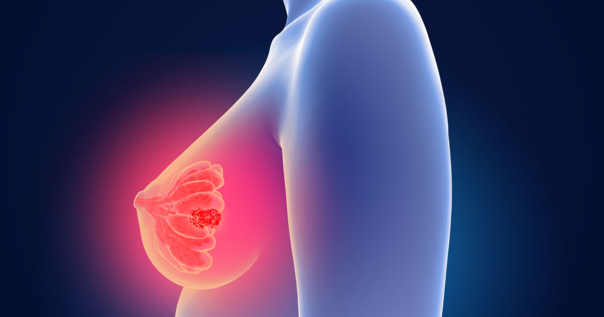 TS-1、ER+HER2-乳がん術後療法に適応拡大/大鵬