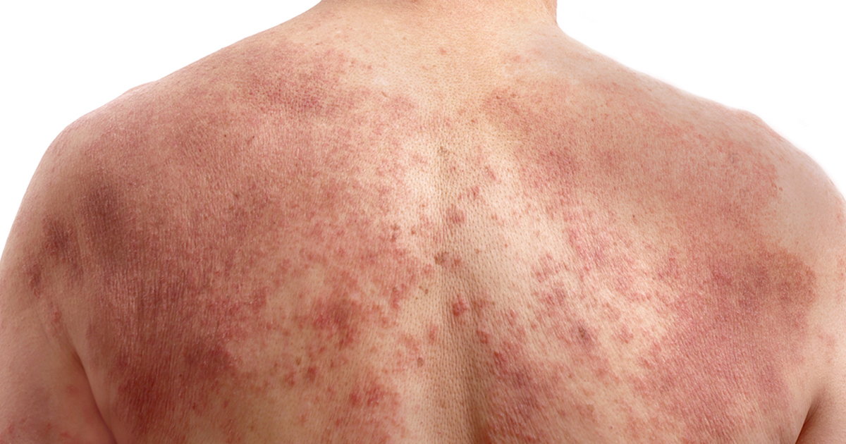 アトピー性皮膚炎、抗IL-13抗体薬のステロイドへの上乗せは有用か?