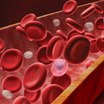 血友病Aの新規治療薬、既治療重症例の出血を低減／NEJM