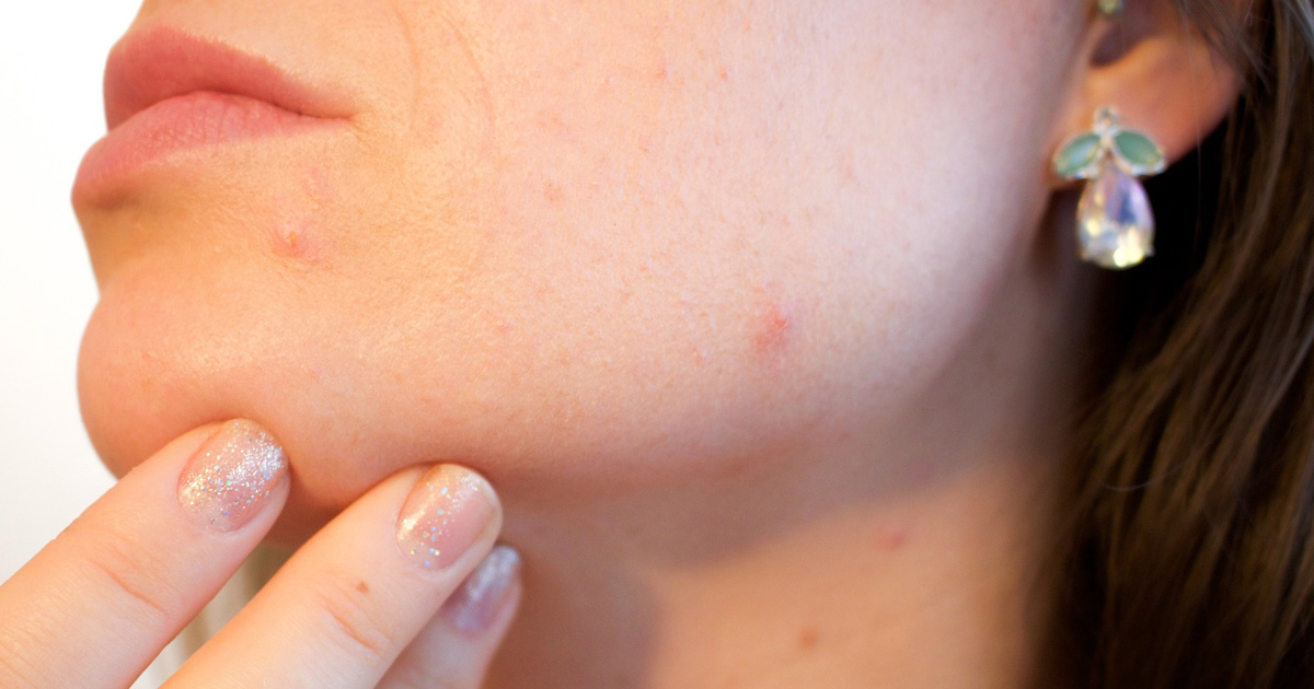 garadacimab、遺伝性血管性浮腫の発作数を低減／Lancet
