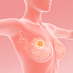 T-DXd、HER2低発現乳がんに適応拡大／第一三共