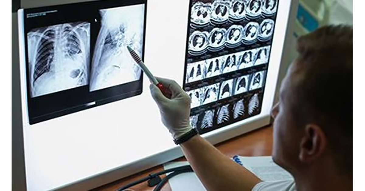 米国がん協会、肺がん検診の対象枠を拡大