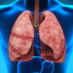 3日間のアミカシン吸入、長期挿管患者の人工呼吸器関連肺炎発生を軽減（解説：栗原宏氏）