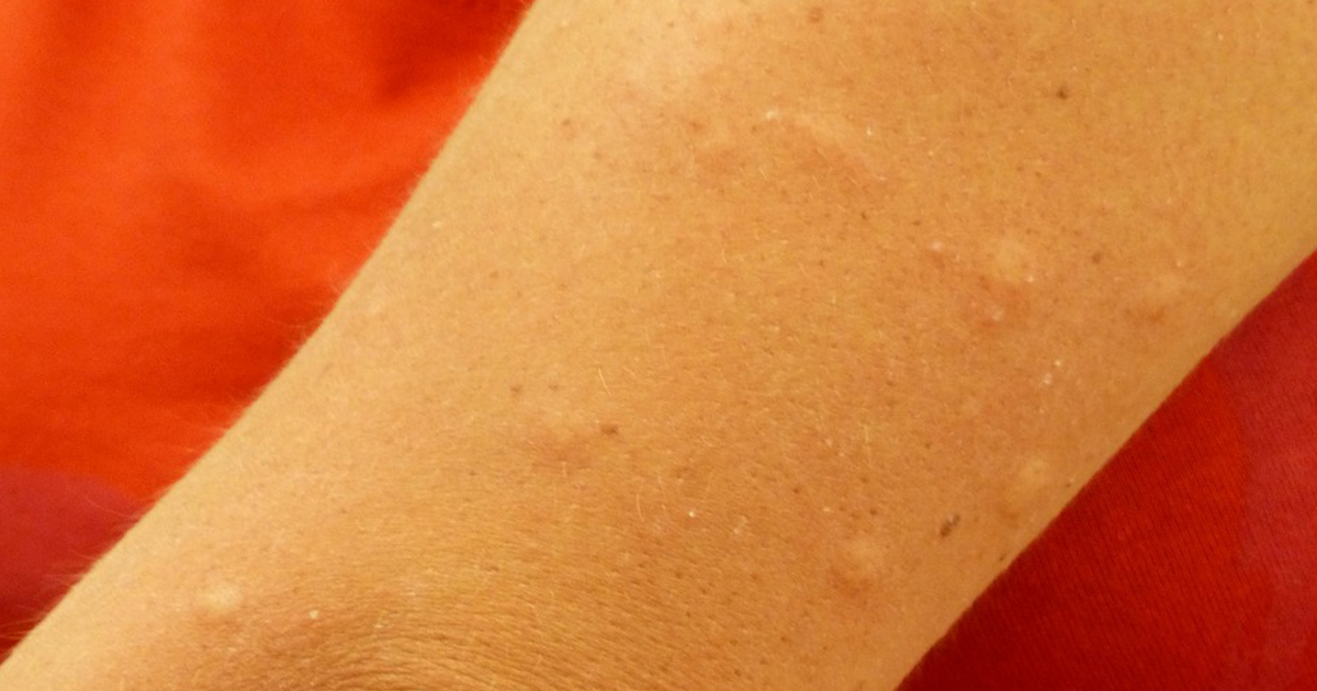 抗ヒスタミン薬が無効の慢性特発性蕁麻疹、ligelizumabの効果は?/Lancet