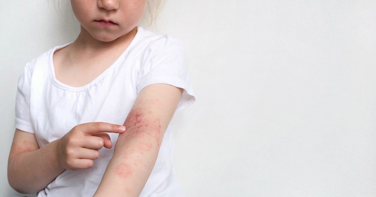 アトピー性皮膚炎は小児の学習・記憶に影響するか？