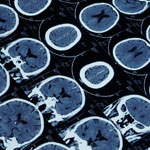ASPECTS 0～5の広範囲脳梗塞にも血管内治療は有効か？／NEJM
