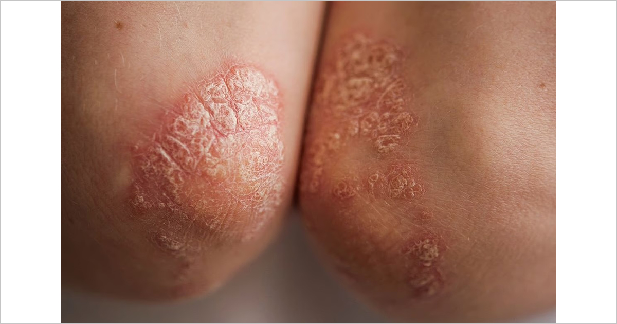 腹部脂肪は乾癬リスクを高める？