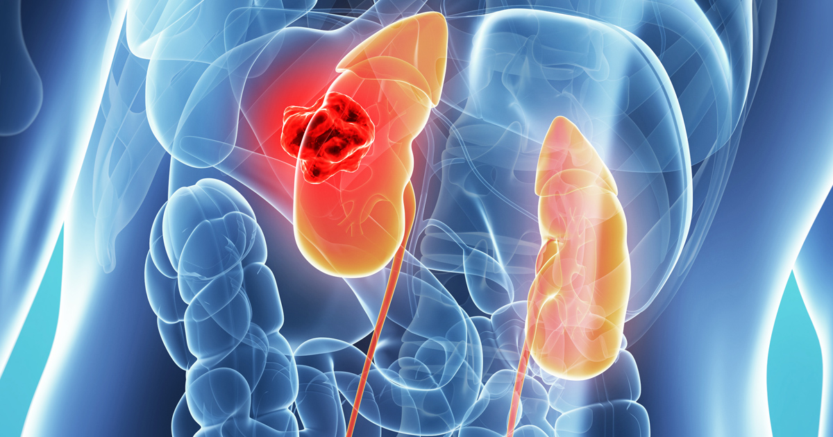 遺伝性・散発性の乳頭状腎細胞がん、ベバシズマブ＋エルロチニブが有望／NEJM