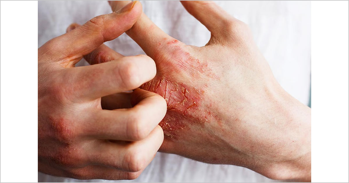 貧血を伴わない鉄欠乏は、中等度～重度のアトピー性皮膚炎で高頻度に認められる