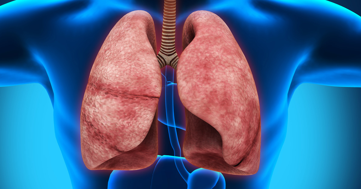 KRAS p.G12D変異あり既治療進行固形がん、setidegrasibの安全性確認／NEJM