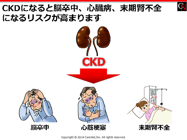 CKDで発症リスクが高まる疾患のイメージ