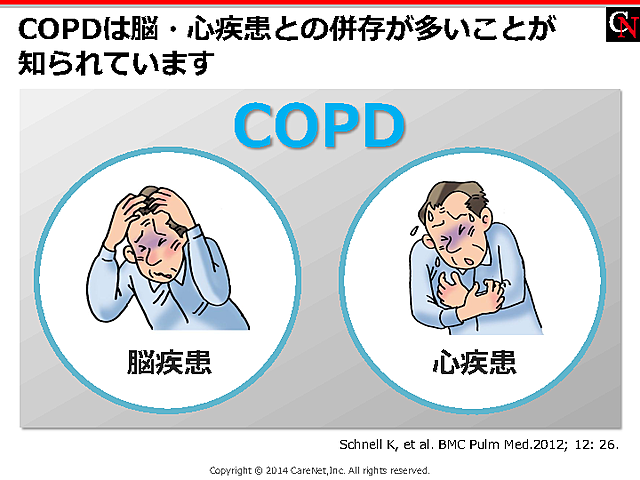 COPDと脳・心疾患の併存のイメージ