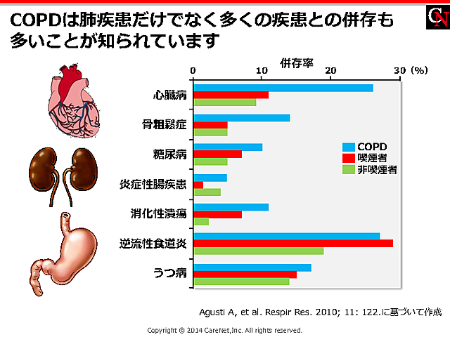 COPDの併存症はさまざまのイメージ