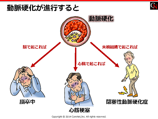 動脈硬化のナレノハテのイメージ