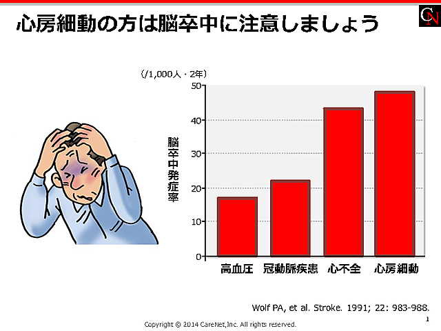 心房細動は脳卒中に注意のイメージ