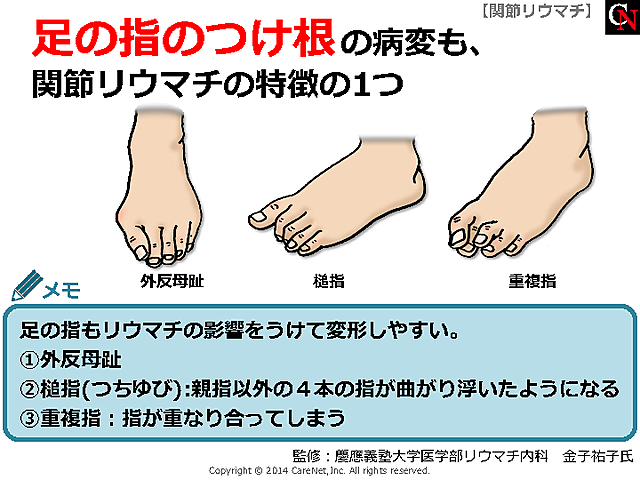 足の指の変形のイメージ
