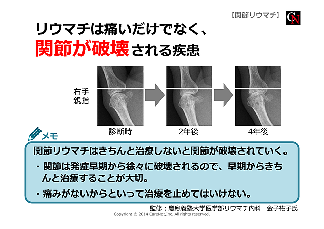 関節が破壊される疾患のイメージ