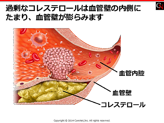 動脈硬化病変のイメージ画像のイメージ