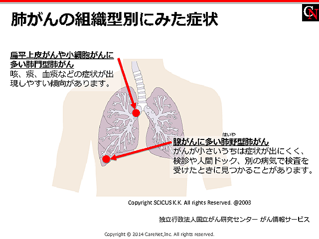肺がんの部位と性状の説明にのイメージ