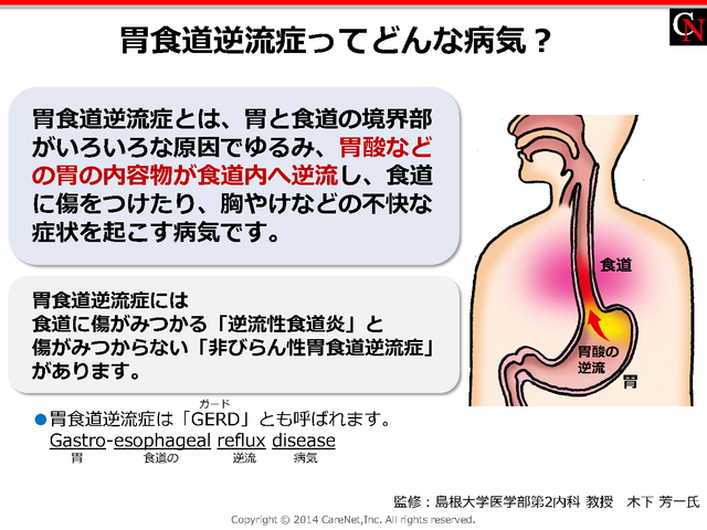 胃食道逆流症とは？のイメージ