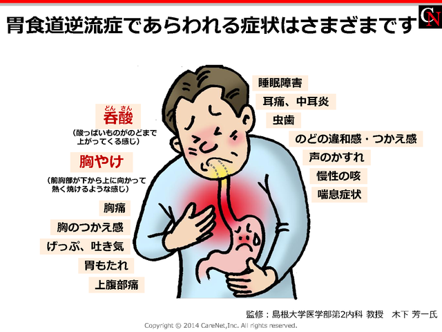 胃食道逆流症の症状のイメージ