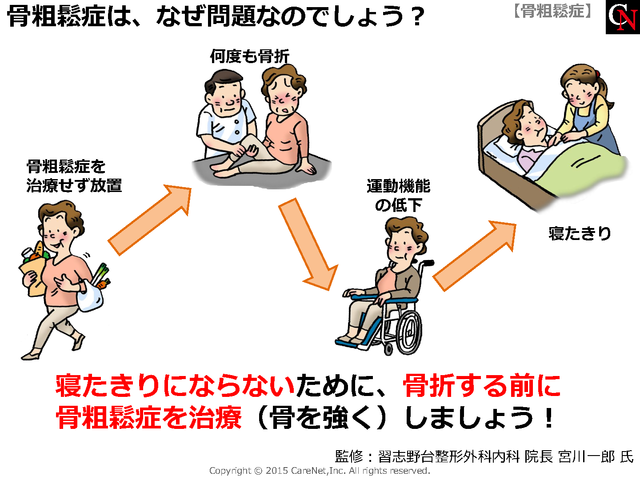 骨粗鬆症の何が問題？のイメージ