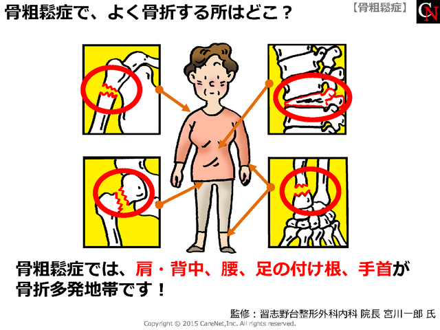 骨折多発地帯はどこ？のイメージ