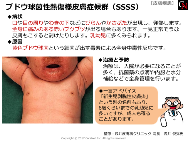 ブドウ球菌性熱傷様皮膚症候群（SSSS)のイメージ