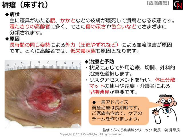 褥瘡（床ずれ）のイメージ