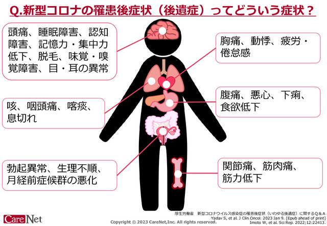 新型コロナの罹患後症状（後遺症）ってどういう症状？のイメージ